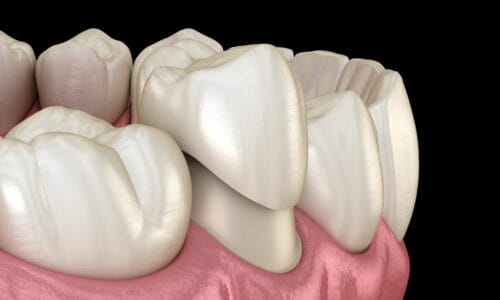 Smiles By Choice Dental Crowns