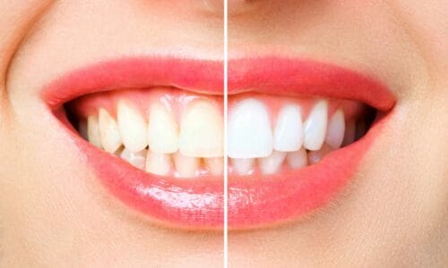 Smiles By Choice Teeth Whitening