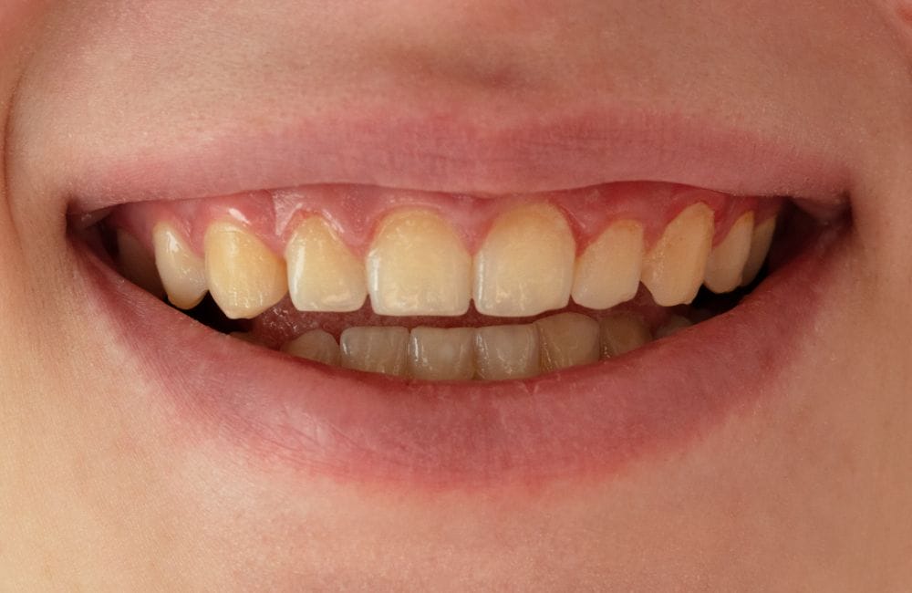The Unfair Stigma of Yellow Teeth