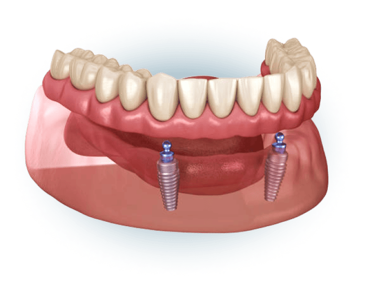 3D rendering of a lower denture supported by two dental implants