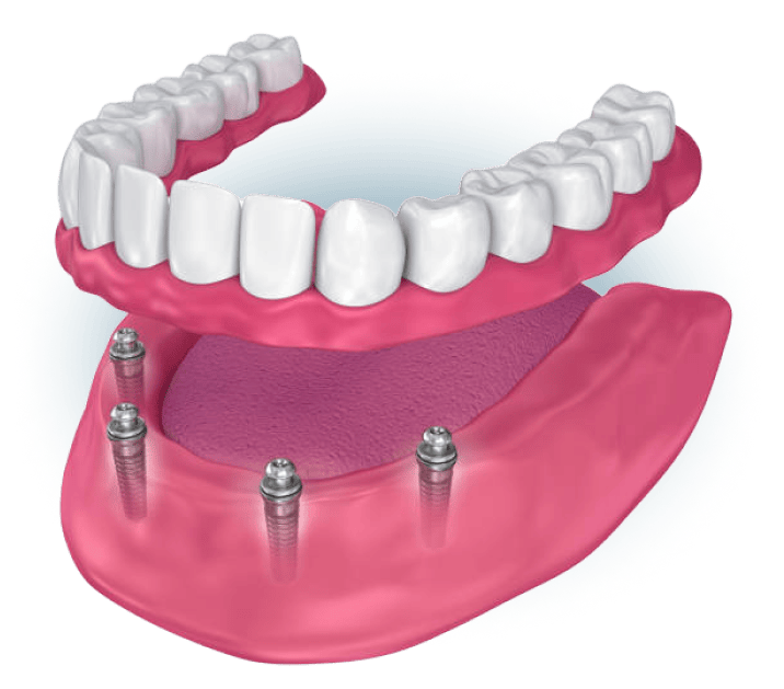 3D rendering of a full arch denture supported by four dental implants in the lower jaw