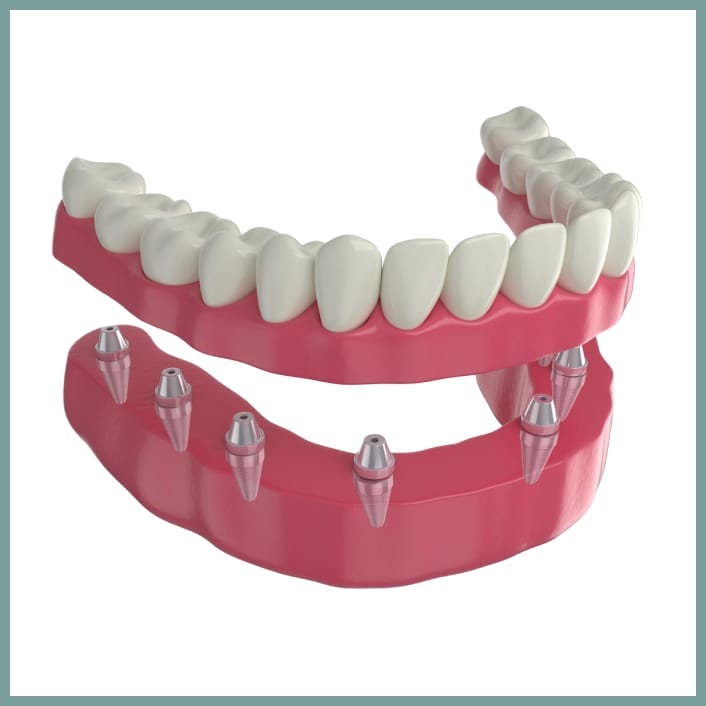 3D rendering of full arch implant-supported dentures with six implants in the lower jaw
