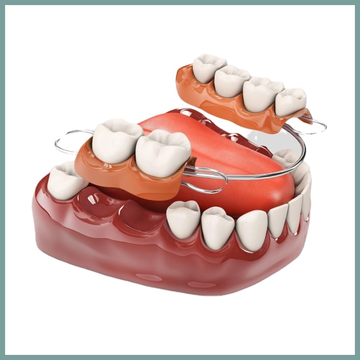 3D illustration of a partial denture with metal clasps fitted over the lower jaw