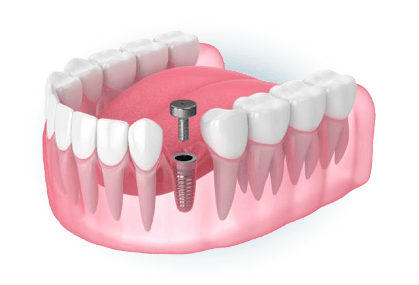 3D illustration of a single dental implant being installed with abutment and crown