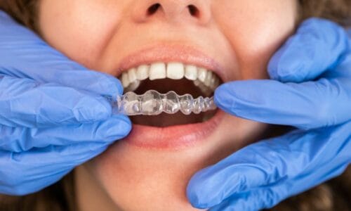 smilesbychoice-Invisalign