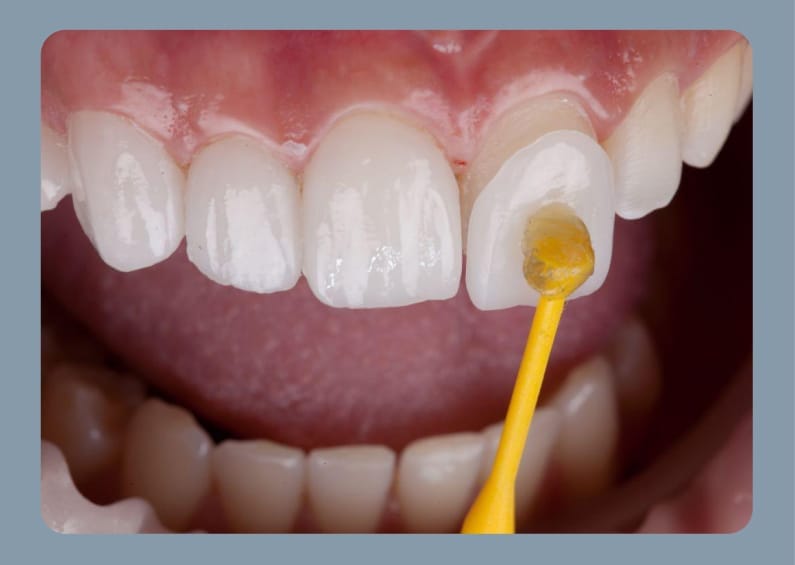 Close-up of a dental veneer being applied to a front tooth with a small brush