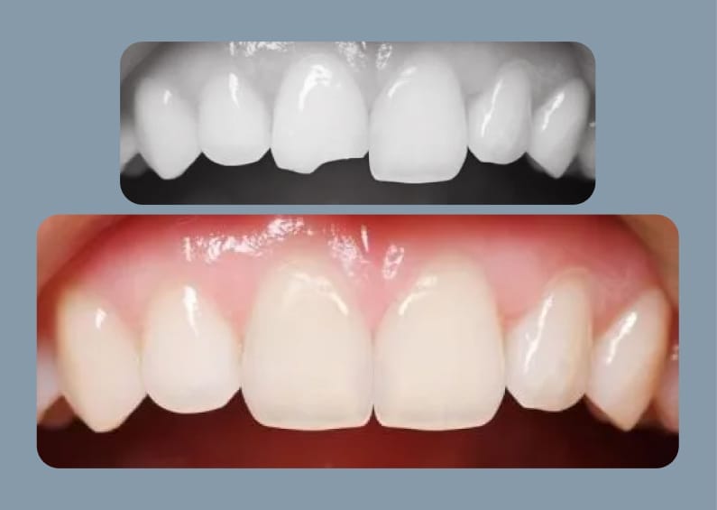 Before and after comparison of teeth whitening shown in black-and-white and color photos