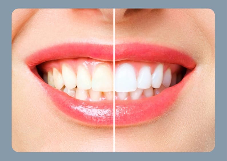 Close-up of a smile showing teeth whitening results with a before-and-after comparison